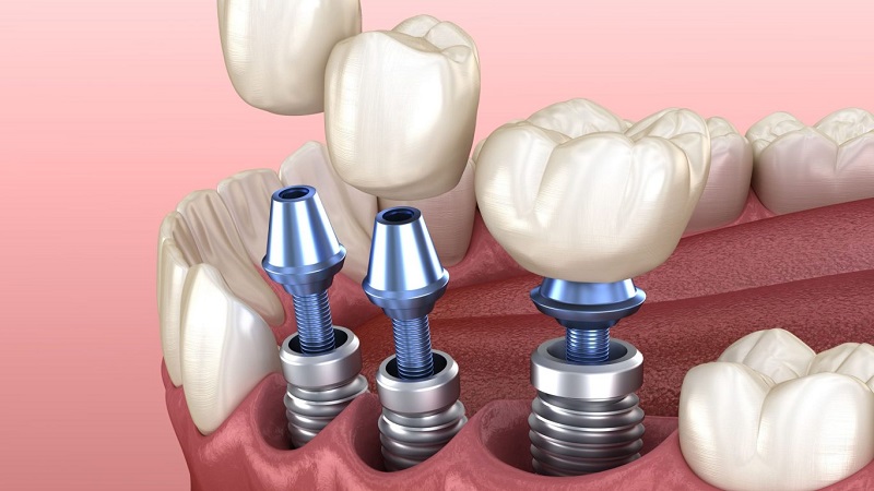 روش‌های افزایش ماندگاری ایمپلنت دندان | بهترین دندانپزشک اصفهان