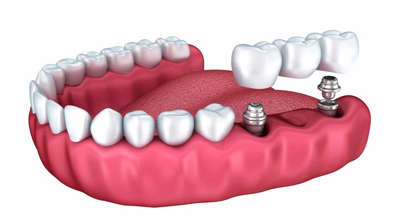 Different methods of implanting bridge teeth | The best dentist in Isfahan