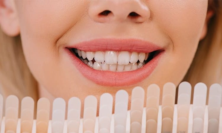 طول عمر مفید لمینت دندان | بهترین دندانپزشک زیبایی اصفهان