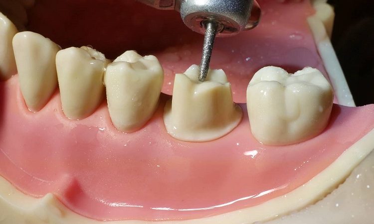 Les raisons de l'exécution et la durée de l'accumulation de dents | Le meilleur chirurgien des gencives à Ispahan