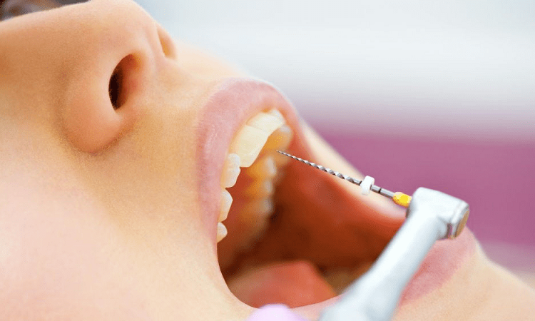 علل و نحوه عصب کشی و درمان ریشه دندان | بهترین دندانپزشک زیبایی اصفهان