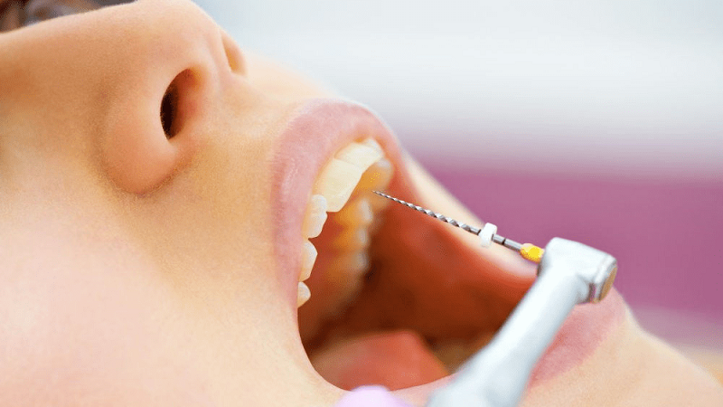 علل و نحوه عصب کشی و درمان ریشه دندان | بهترین دندانپزشک زیبایی اصفهان