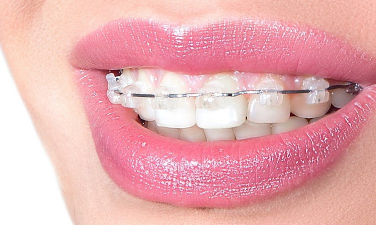 عوارض و معایب انجام ارتودنسی دندان | بهترین دندانپزشک اصفهان