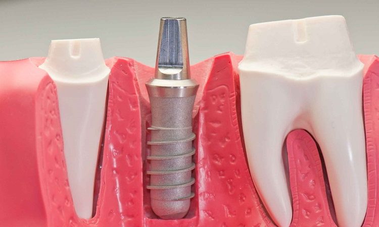 Factors determining the number of implants | The best dentist in Isfahan