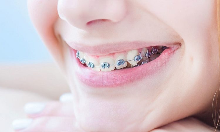 عوامل موثر در ماندگاری درمان ارتودنسی دندان | بهترین دندانپزشک زیبایی اصفهان
