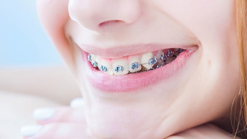 عوامل موثر در ماندگاری درمان ارتودنسی دندان | بهترین دندانپزشک زیبایی اصفهان
