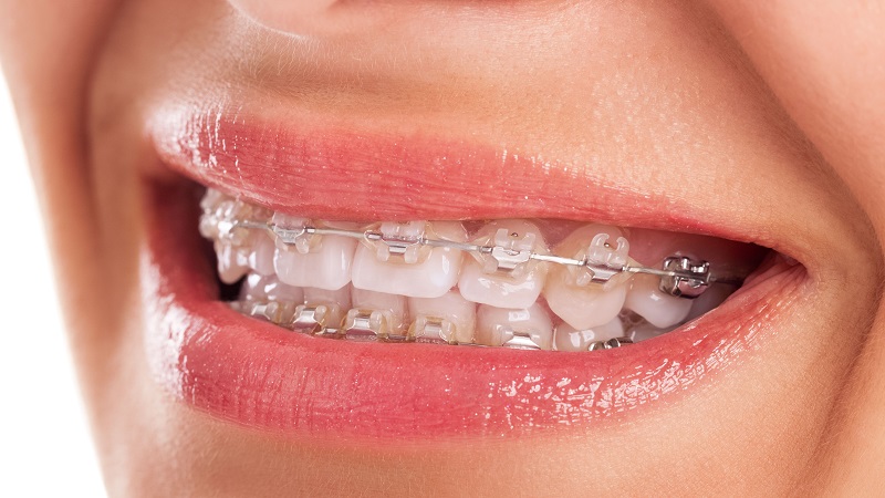 مزایا ، عیوب و اصول مراقبتی ارتودنسی سرامیکی دندان | بهترین دندانپزشک زیبایی اصفهان