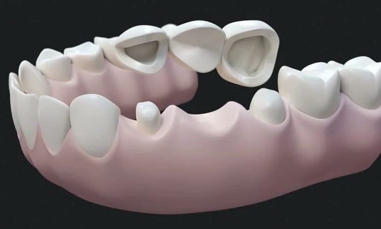 بررسی مزایا و معایب بریج دندان | بهترین دندانپزشک اصفهان