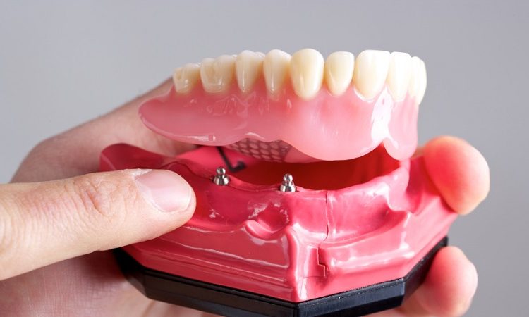 The advantages of overdenture | The best gum surgeon in Isfahan