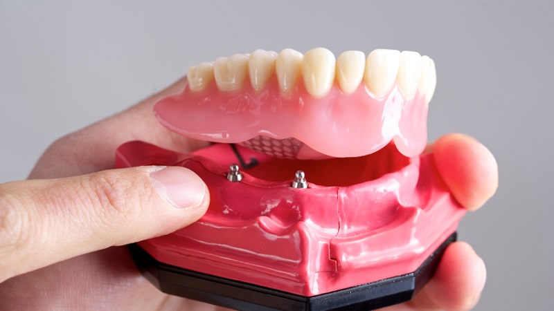 The advantages of overdenture | The best gum surgeon in Isfahan