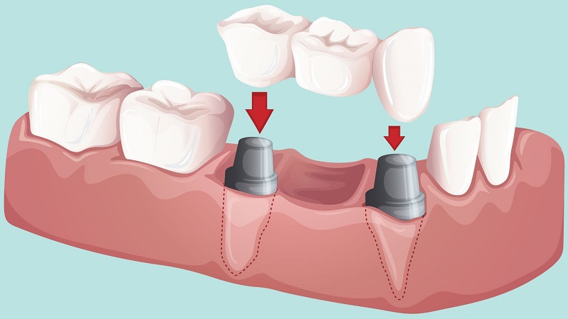مقایسه برتری های بریج و ایمپلنت دندان بر یکدیگر | بهترین دندانپزشک اصفهان