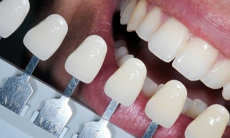 نکات مراقبتی پس از انجام لمینت ای پی اس | Le meilleur dentiste d'Ispahan