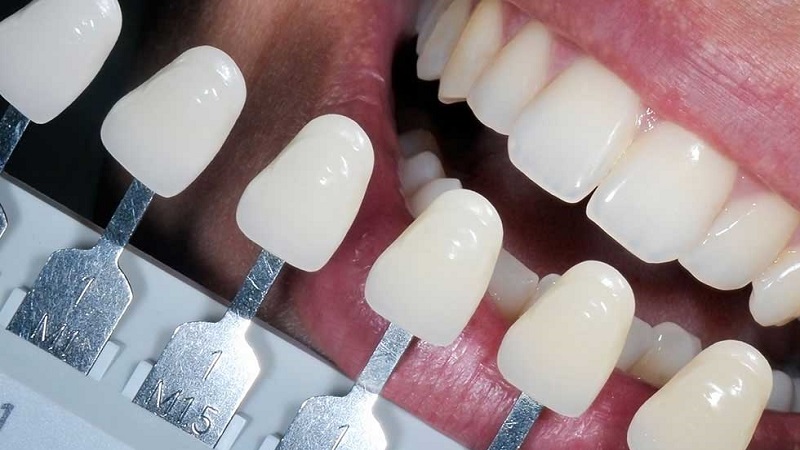 نکات مراقبتی پس از انجام لمینت ای پی اس | بهترین دندانپزشک اصفهان