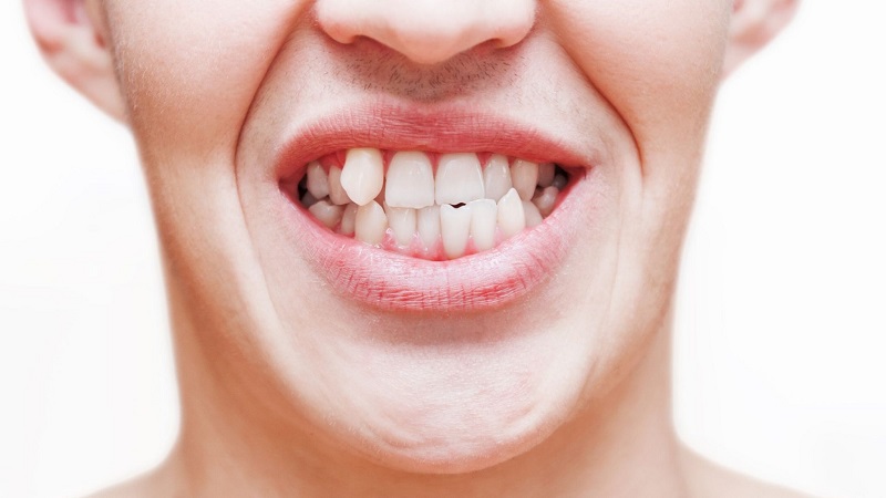 همه چیز راجع به لمینت دندان های کج | بهترین جراح لثه اصفهان