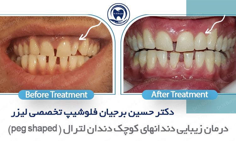نمونه درمان زیبایی دندان های زیبایی لترال| بهترین دندانپزشک اصفهان