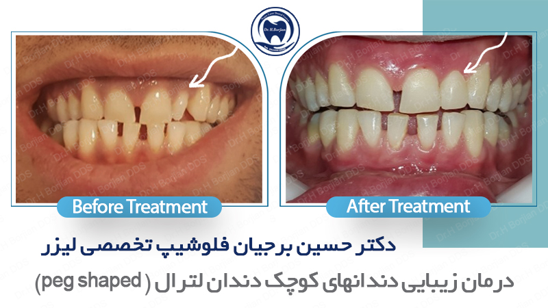 نمونه درمان زیبایی دندان های زیبایی لترال| افضل دكتور اسنان في اصفهان