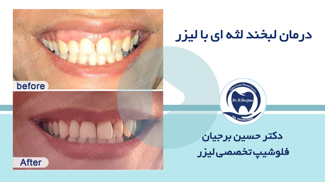 نمونه درمان لبخند لثه ای با لیزر (3)|بهترین دندانپزشک اصفهان
