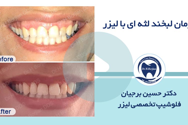 مثال على علاج الابتسامة اللثوية بالليزر (3)|افضل دكتور اسنان في اصفهان