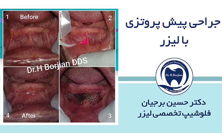 نمونه جراحی پیش پروتزی با لیزر (2) | بهترین دندانپزشک اصفهان