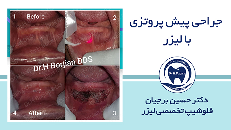 نمونه جراحی پیش پروتزی با لیزر (2) | بهترین دندانپزشک اصفهان