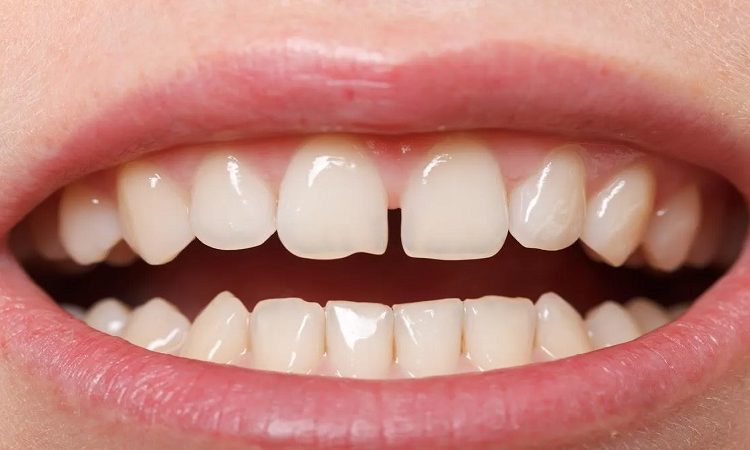 أهمية سد الفجوة بين الأسنان | أفضل جراح لثة في اصفهان