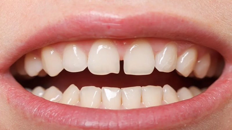 L’importance de combler l’écart entre les dents | Le meilleur chirurgien des gencives à Ispahan