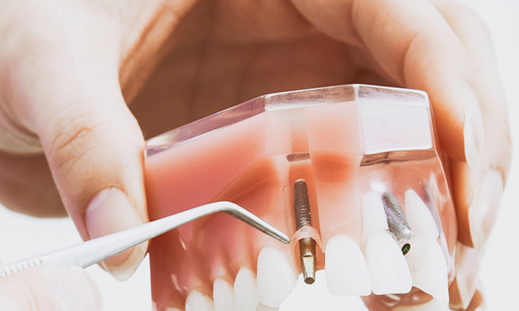 التحقيق في مضاعفات وعيوب زراعة الأسنان المصغرة | افضل دكتور اسنان تجميلي في اصفهان