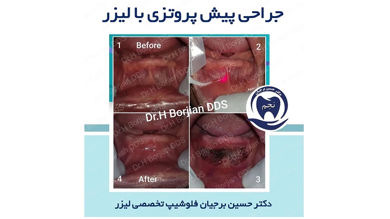 نمونه جراحی های پیش پروتزی (Vestibuloplasty) with a laser | The best implant in Isfahan