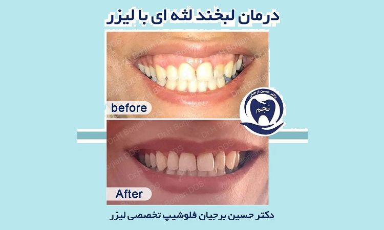 Un exemple de traitement du sourire gingival au laser | Le meilleur implant à Ispahan