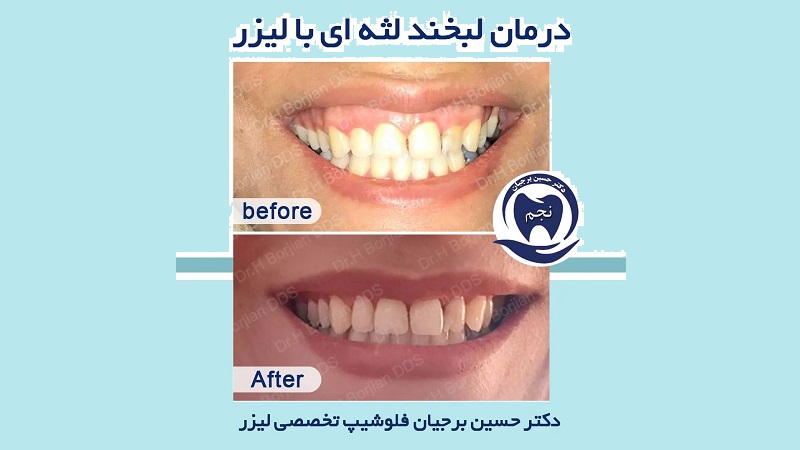 نمونه درمان لبخند لثه ای با لیزر | بهترین ایمپلنت اصفهان