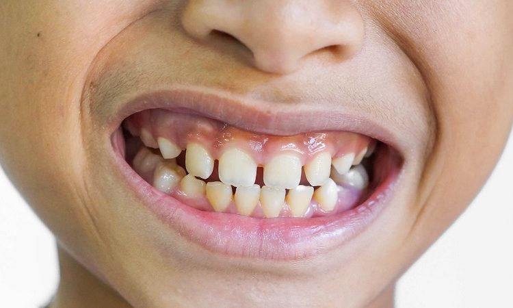 روش های درمان و اصلاح فاصله بین دندان کودکان | بهترین دندانپزشک زیبایی اصفهان