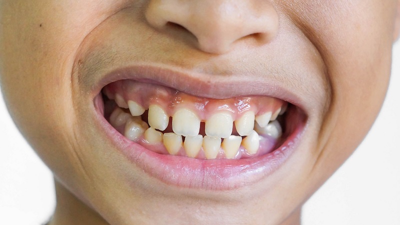 Méthodes de traitement et de correction de la distance entre les dents des enfants | Le meilleur dentiste cosmétique à Ispahan