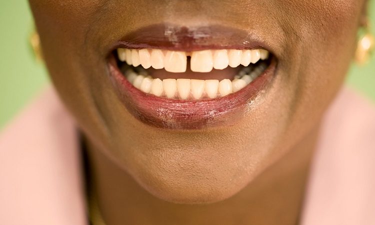 طرق علاج تباعد الأسنان | افضل دكتور اسنان تجميلي في اصفهان