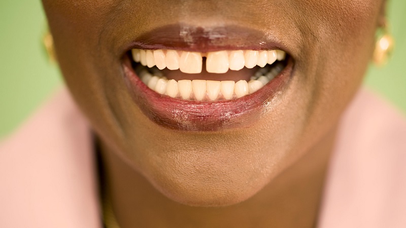 روش های درمانی برای دندان های فاصله دار | Le meilleur dentiste cosmétique à Ispahan
