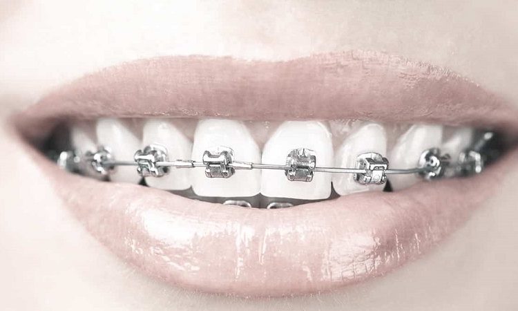 روش های پیشگیری از بروز عوارض ارتودنسی دندان | بهترین جراح لثه اصفهان