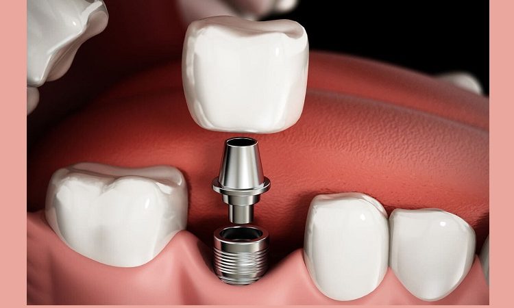 Méthodes de prévention et de traitement de l'échec des implants dentaires | Le meilleur dentiste cosmétique à Ispahan