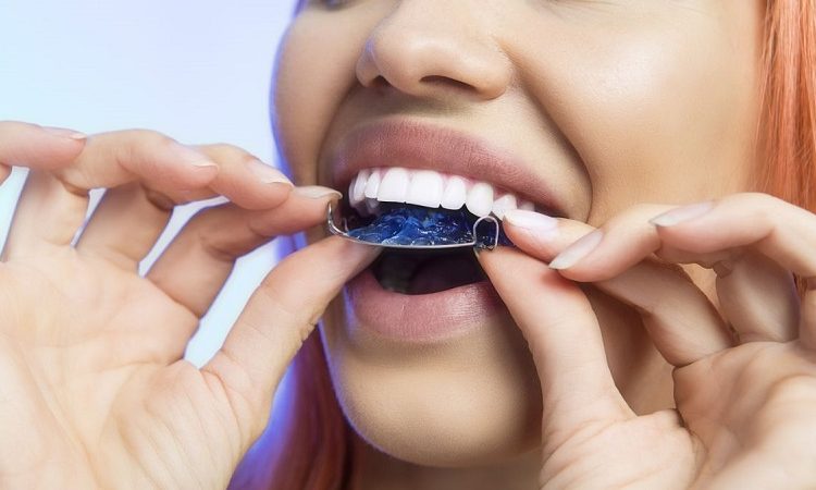 مراحل انجام ارتودنسی متحرک و نکات مراقبتی | بهترین دندانپزشک زیبایی اصفهان