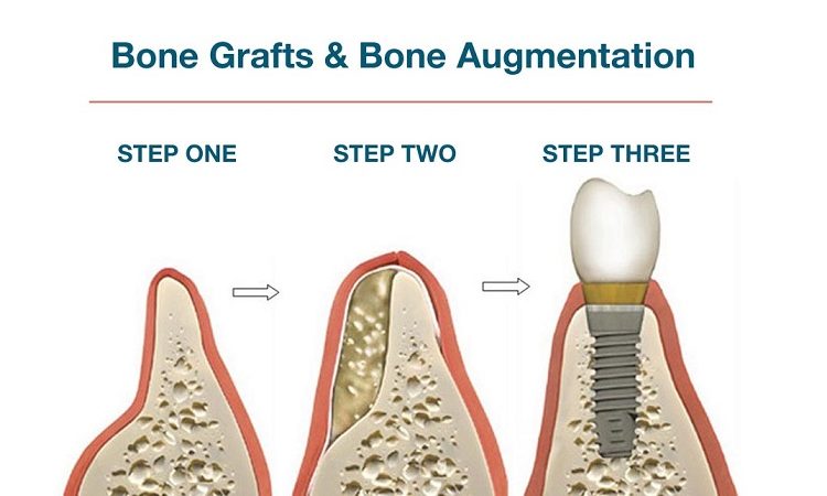 Advantages and disadvantages of bone grafting in dental implants | The best cosmetic dentist in Isfahan