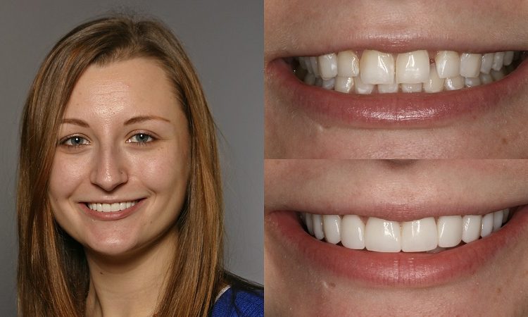 Conseils d'entretien avant et après le composite des dents de devant | Le meilleur dentiste cosmétique à Ispahan