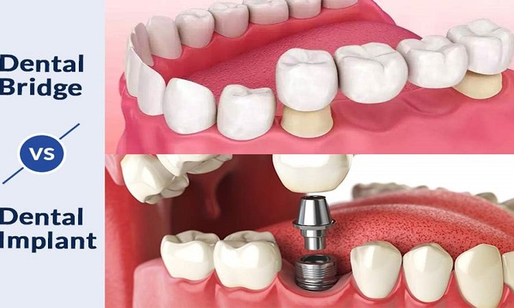 مقایسه کابردهای ایمپلنت دندان و بریج دندان | بهترین دندانپزشک زیبایی اصفهان