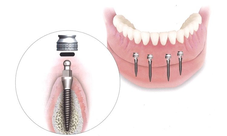 تفاوت کاربردهای مینی ایمپلنت دندان | بهترین جراح لثه اصفهان