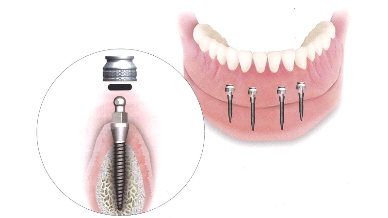 تفاوت کاربردهای مینی ایمپلنت دندان | بهترین جراح لثه اصفهان