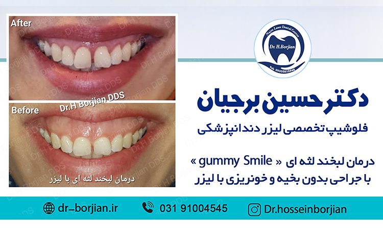 نمونه درمان لبخند لثه ای با جراحی با لیزر|بهترین دندانپزشک اصفهان