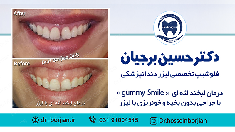 نمونه درمان لبخند لثه ای با جراحی با لیزر|بهترین دندانپزشک اصفهان