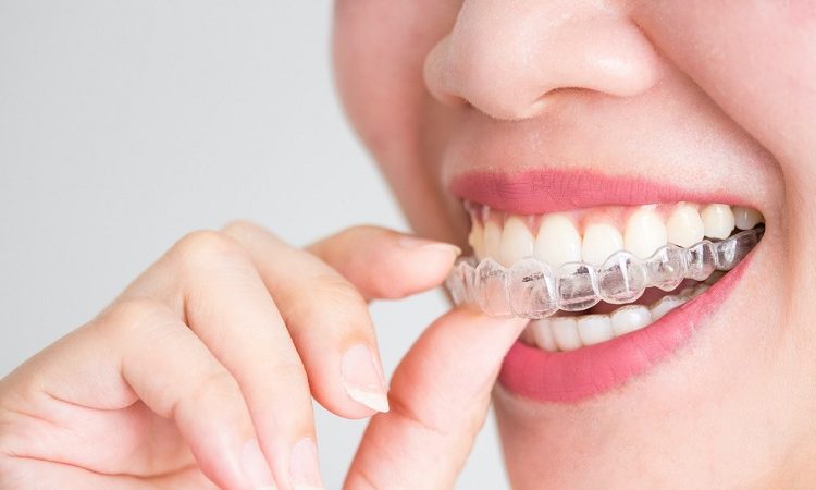 كيفية استخدام التقويم الشفاف لتقويم الأسنان | افضل دكتور اسنان تجميلي في اصفهان