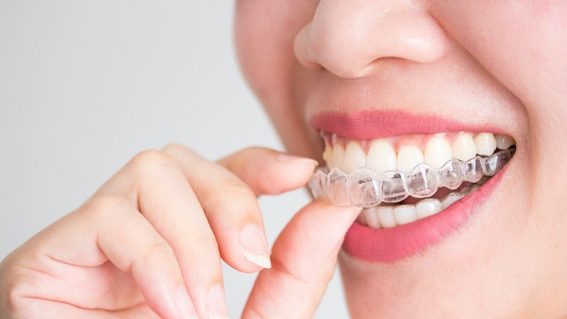 نحوه استفاده از الاینر شفاف برای درمان ارتودنسی | بهترین دندانپزشک زیبایی اصفهان