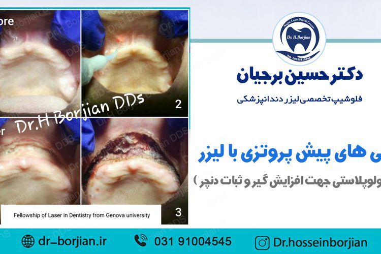 نمونه جراحی پیش پروتزی (3) | بهترین دندانپزشک اصفهان