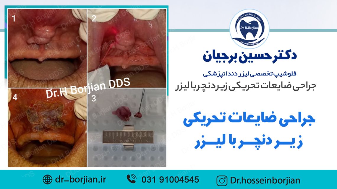 نمونه جراحی ضایعات تحریکی زیر دنچر با لیزر | بهترین دندانپزشک اصفهان