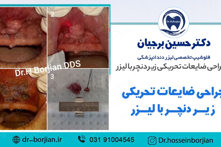 نمونه جراحی ضایعات تحریکی زیر دنچر با لیزر | بهترین دندانپزشک اصفهان