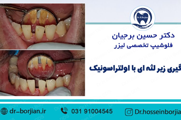 نمونه جرمگیری اولتراسونیک با لیزر (5) |بهترین دندانپزشک اصفهان